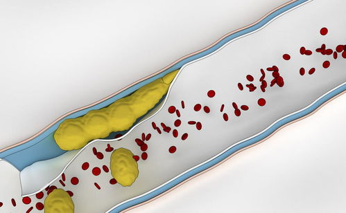 控制飲食降低壞血脂 健康投資與醫(yī)療費(fèi)用節(jié)約的雙贏策略